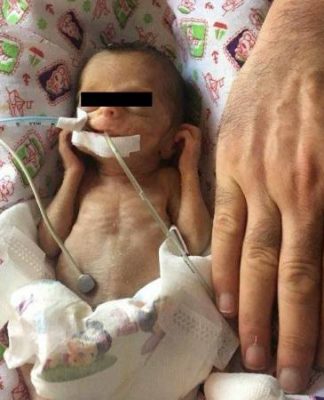 Հայաստանում առաջին անգամ 680 գրամանոց երեխային ենթարկել են սրտի վիրահատության